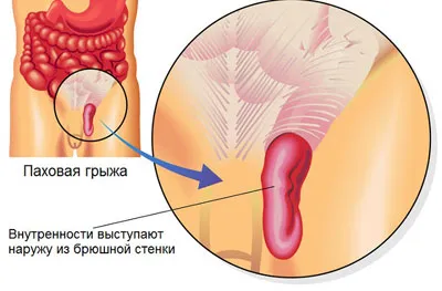 Лечение на ингвинална херния без хирургични терапии