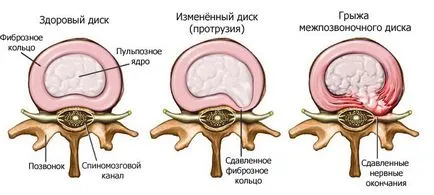 Лазерно лечение херния