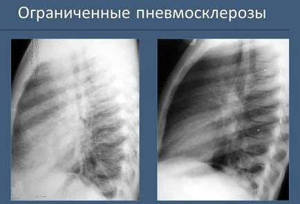 Лечение на белодробна фиброза