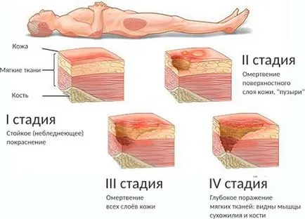 Лечението на рани от залежаване при по-възрастните какво е, как да се борим и да се премахне, превенция