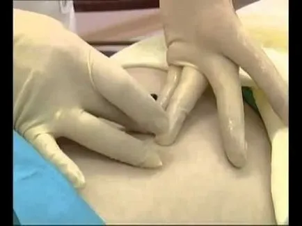 Лечение на хемороиди с пиявици - ефективност Основен залог и ревюта