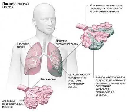 Лечение на белодробна фиброза народната медицина