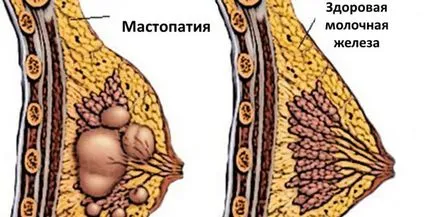 Какво е влакнести гърди на гърдата