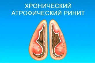 Мога ли да се затопли на носа със студена сол - как да се затопли