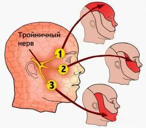 Невралгия на лицевия нерв симптоми и лечение (симптоми) Невралгия лицевия нерв симптоми и лечението
