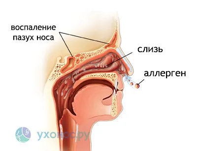 Подуването на носната лигавица набъбва причини, лечението