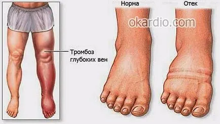 подуване на краката в сърдечна недостатъчност причини, симптоми, лечение