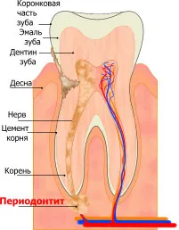 лечение пародонтит