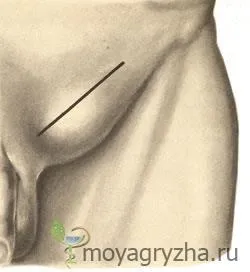 Ингвинална херния лечение без операция