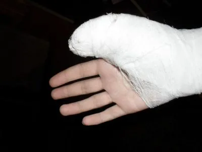 Фрактура на малкия пръст, палецът на симптомите за ръка и лечение, как да се идентифицират