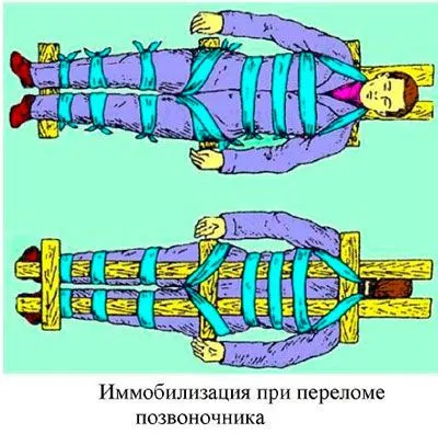 Гръбнак фрактура лечение, симптоми, ефекти, класификация и видове градуса