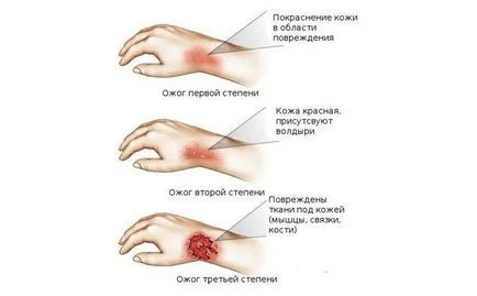 Първа помощ при изгаряния топла вода в дома