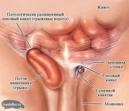 Ингвинална херния лечение без операция