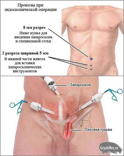 Ингвинална херния лечение без операция