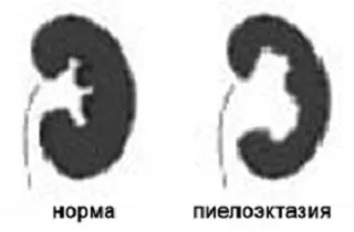 pyelectasia бъбреците при децата от основните причини за (външния вид) pyelectasia бъбреците при децата от основните причини за