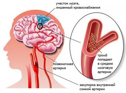 Защо възпалено врата и главата симптоми и лечение на шийката на матката мигрена, какво да правят, ако се чувствате замаяни и болка