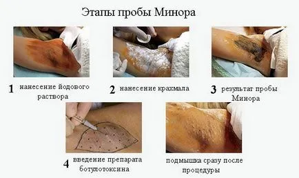 Мишниците изпотяване причини, как да се отървете, прегледът на фармацевтични препарати (под мишниците) Мишниците изпотяване причини, как да се отървете, прегледът на фармацевтични препарати