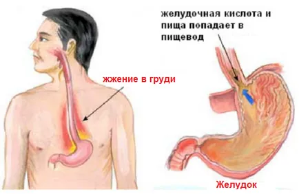 Постоянно киселини в стомаха ...