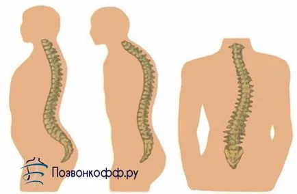 Причините за появата и развитието на гръбначния херния (причина) Причините за възникването и развитието на гръбначния херния