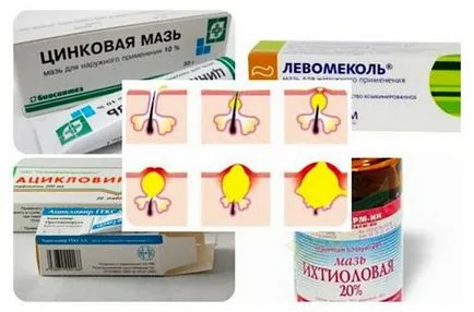 Акне на причините храмовете, типовете, това, което те казват, как да се отървете от (причините) Акне на слепоочията причини, видове, това, което те казват, как да се отървете