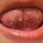 Bubble под причините език на и лечения
