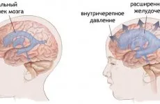 Псевдомехурчеста парализа и булбарна разстройство, което е