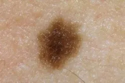 Mole по врата причинява и как да се отървете
