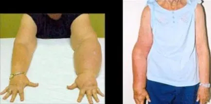 Еризипел ръце (и не само)