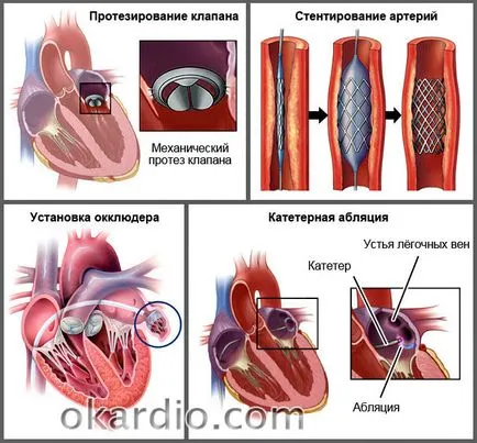 Симптомите на сърдечна недостатъчност, лечение, какво е това