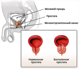 Простатит при мъжете каузи