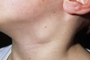 Възпалени лимфни възли отколкото лечение