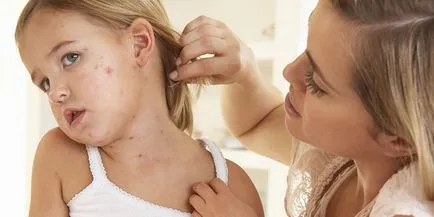 Скарлатина при деца лечение, превенция и усложнения