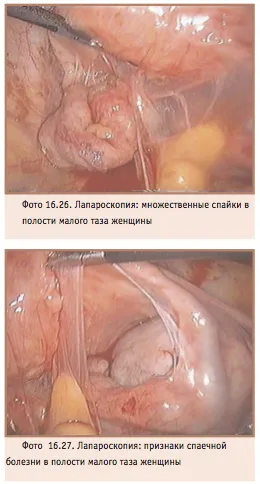 Сраствания на яйчниците, поради които трябва да бъдат лекувани своевременно