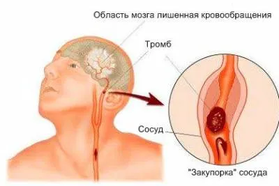 Церебрална лечение вазоспазъм, вазоспазъм и симптоми на вазоконстрикция