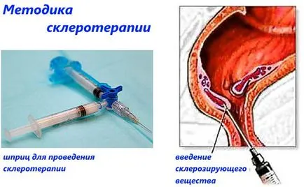 Съвременни техники и методи за лечение на хемороиди (модерен) Съвременните техники и методи за лечение на хемороиди