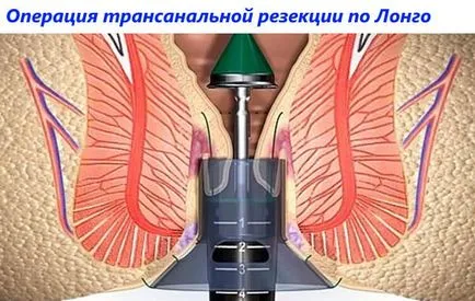 Съвременни техники и методи за лечение на хемороиди (модерен) Съвременните техники и методи за лечение на хемороиди