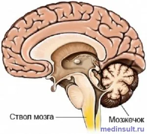 Стволови инсулт причини, възстановяване перспектива (мозъчния ствол) Стволовите двутактови причини, перспективи за възстановяване