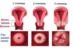 гинекология онкология