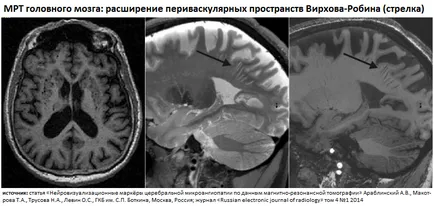 Каква е перисъдово пространство