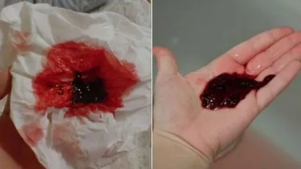 Кръвни съсиреци какво Кръвни съсиреци какво