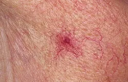 Telangiectasia - лечение, причини, снимка телеангиектазии по лицето (телангиектазии) Telangiectasia - лечение, причини, телеангиектазии лицева снимка