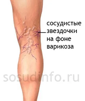 Telangiectasia причини, лечение, методи за обезвреждане (излагане на слънчева светлина) Телангиектазия причини, лечение, методи за изхвърляне