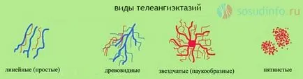 Телангиектазия причини, лечение, методи за обезвреждане (е чисто козметични) Телангиектазия причини, лечение, методи за изхвърляне