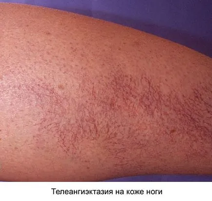 Telangiectasia какво е, причини, видове, симптоми и лечение