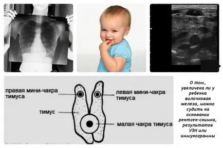 Thymomegalia - причини, признаци, симптоми и лечение (Thymomegalia увеличение тимуса при новородени имунната система причинява лечение симптоми) Thymomegalia - причини, признаци, симптоми и лечение