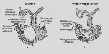 Ephippium мозъка