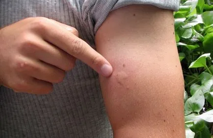 Mosquito ухапване премахване тежка сърбеж и зачервяване на детето и възрастни