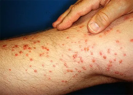 Ant ухапване последици и възможни опасности, методи за лечение,