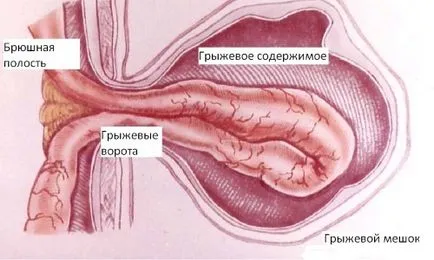 Прищипан херния причини, симптоми, лечение