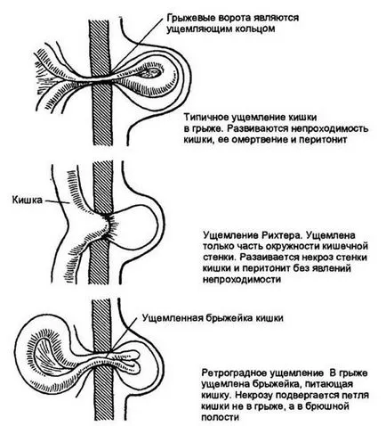 Заклещена херния симптоми, причини и лечения